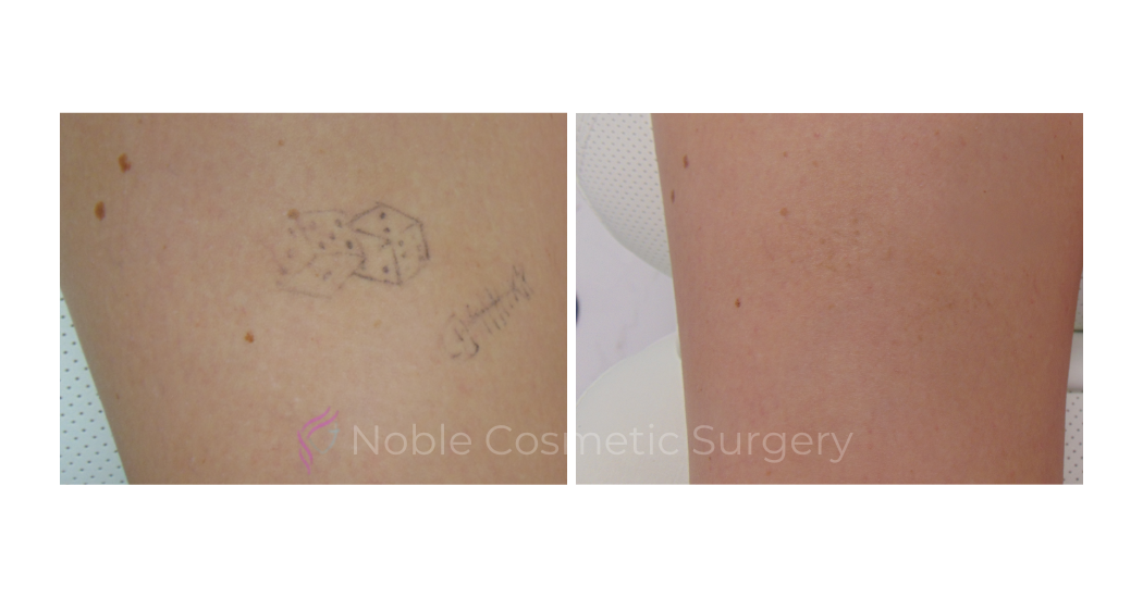 LASER-TATTOO-REMOVAL-CASE-00028 | Before and After Laser Tattoo Removal