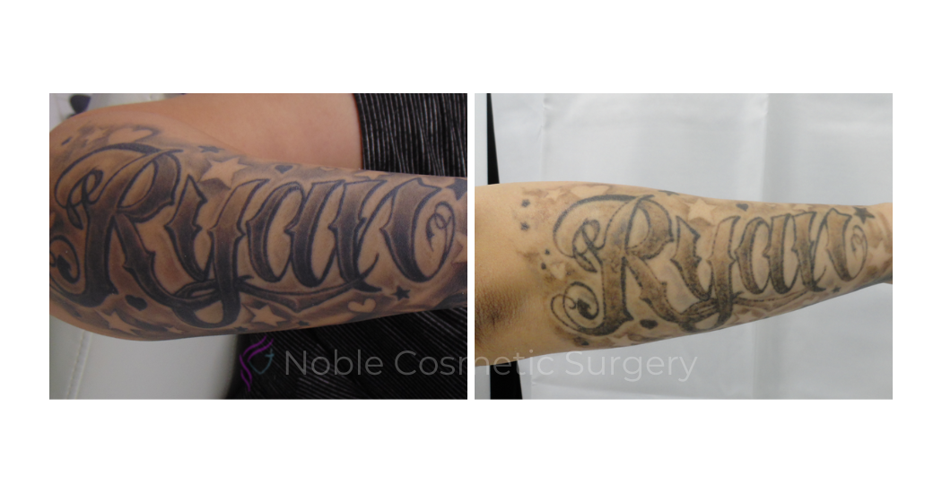 LASER-TATTOO-REMOVAL-CASE-00029 | Before and After Laser Tattoo Removal