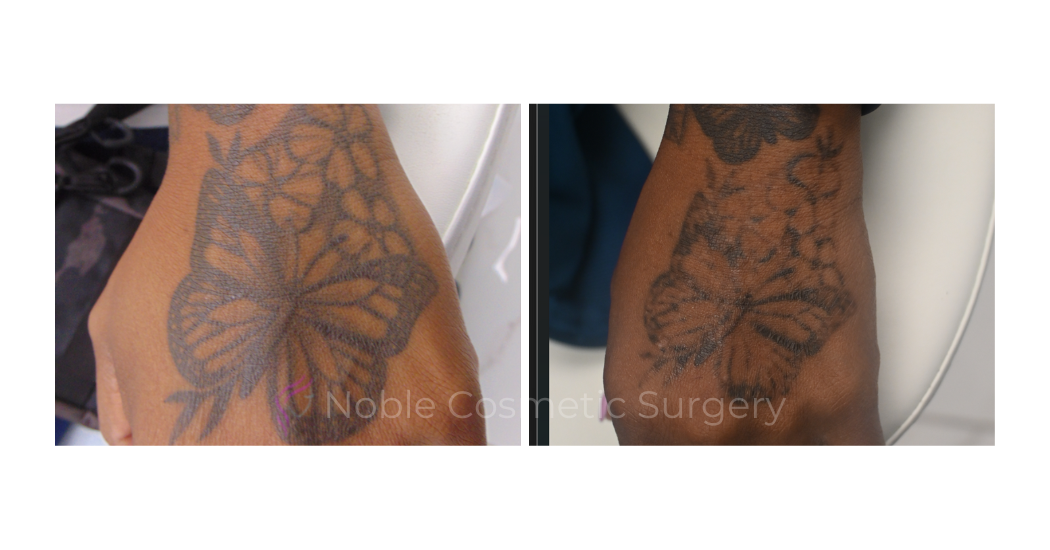 LASER-TATTOO-REMOVAL-CASE-00030 | Before and After Laser Tattoo Removal