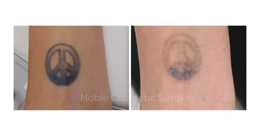 LASER-TATTOO-REMOVAL-CASE-00031 | Before and After Laser Tattoo Removal