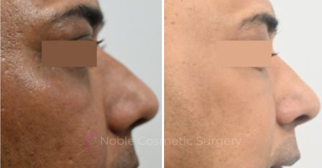 LIQUID-RHINOPLASTY-CASE-10001 | Before and After Liquid Rhinoplasty 1
