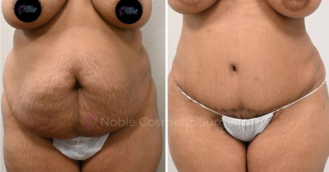 P1-00031A | Before and After Abdominoplasty