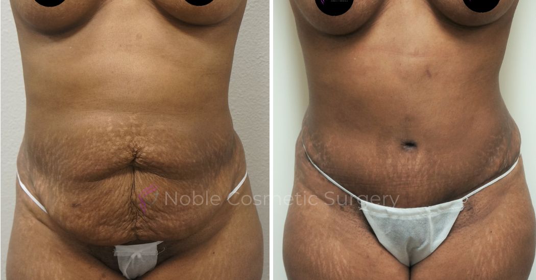 P10-00041A | Before and After Abdominoplasty 1