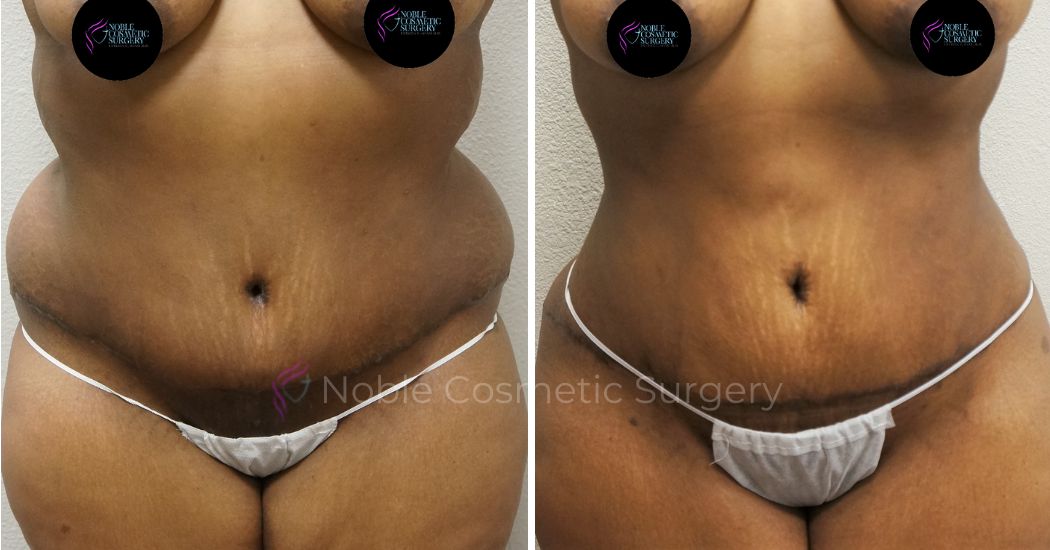 P11-00042A | Before and After Abdominoplasty