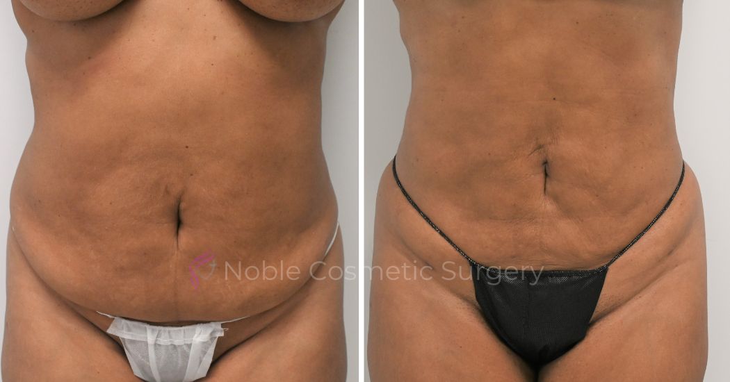 P11-00911L | Before and After Liposuction