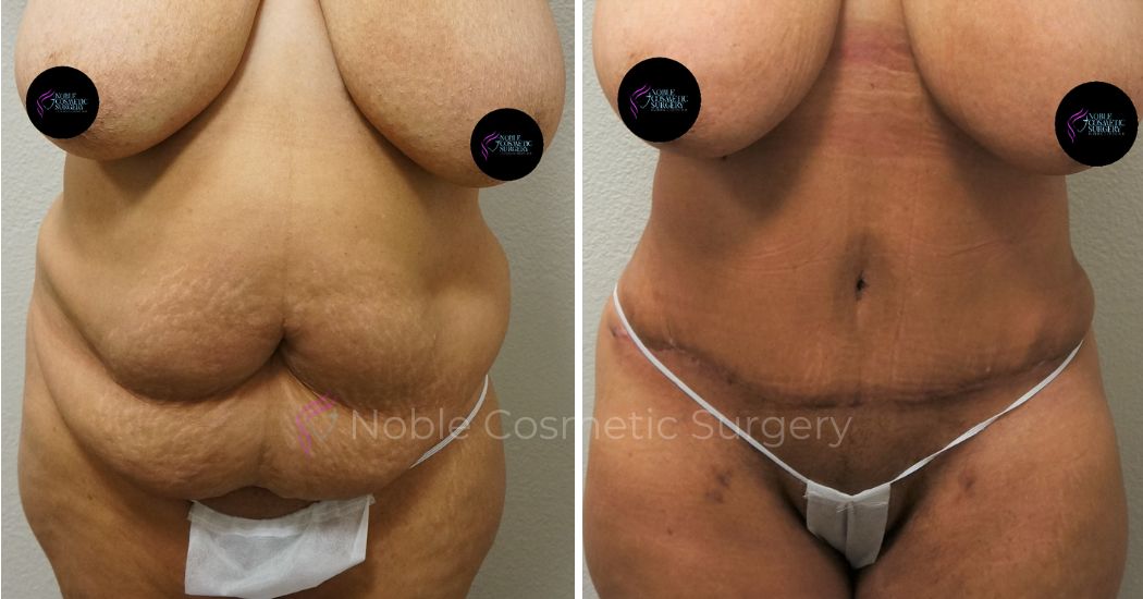 P12-00043A | Before and After Abdominoplasty 1