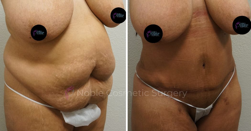P12-00043A | Before and After Abdominoplasty 2