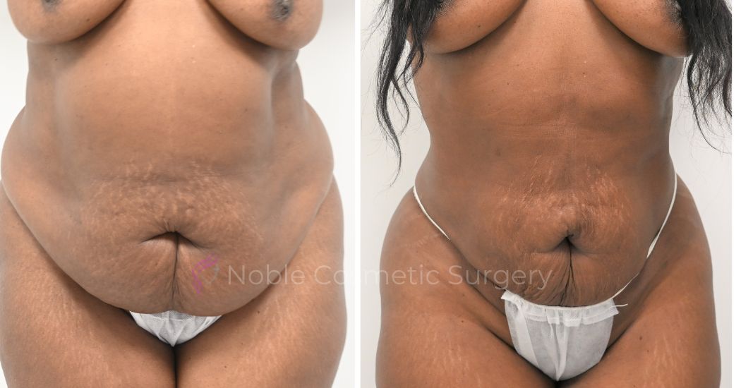 P12-00912L | Before and After Liposuction