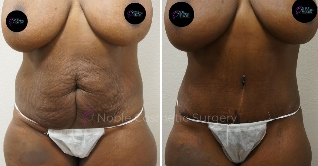 P13-00044A | Before and After Abdominoplasty 1