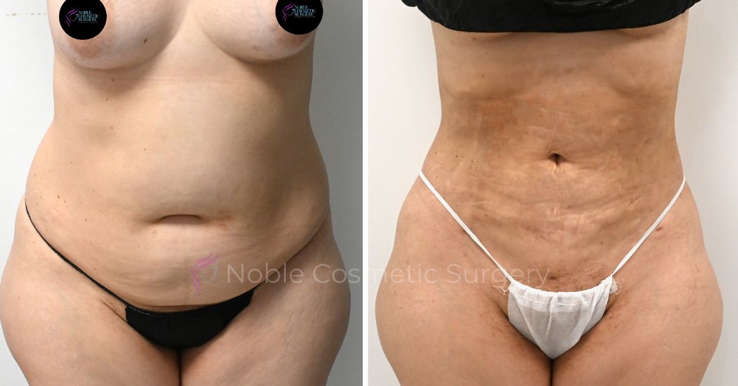 P13-00913L | Before and After Liposuction