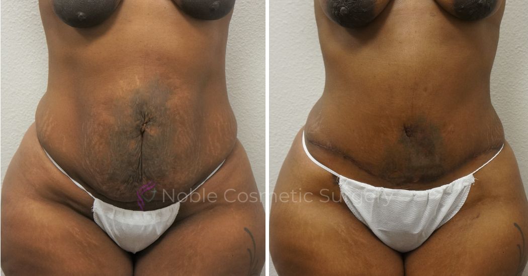 P14-00045A | Before and After Abdominoplasty