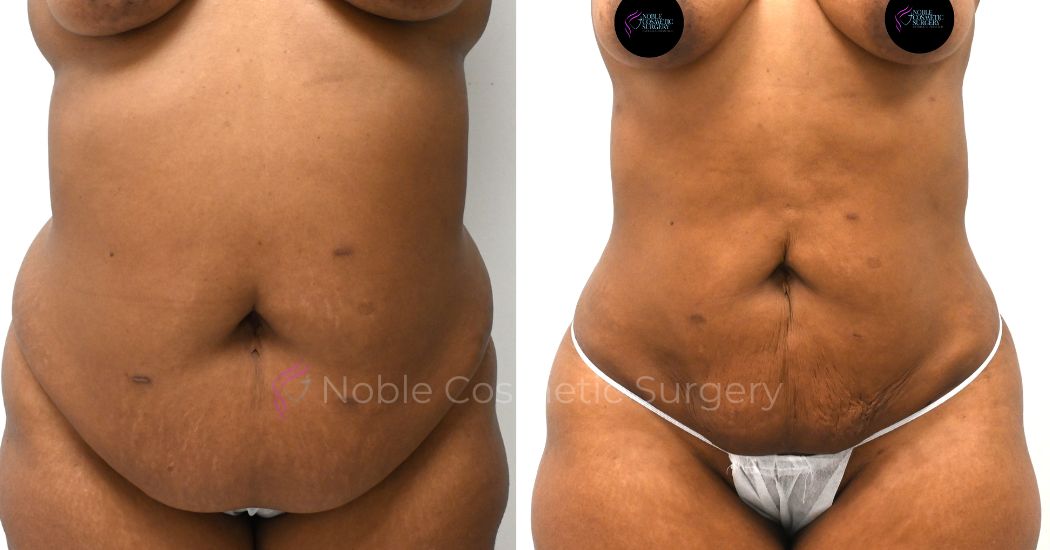 P14-00914L | Before and After Liposuction