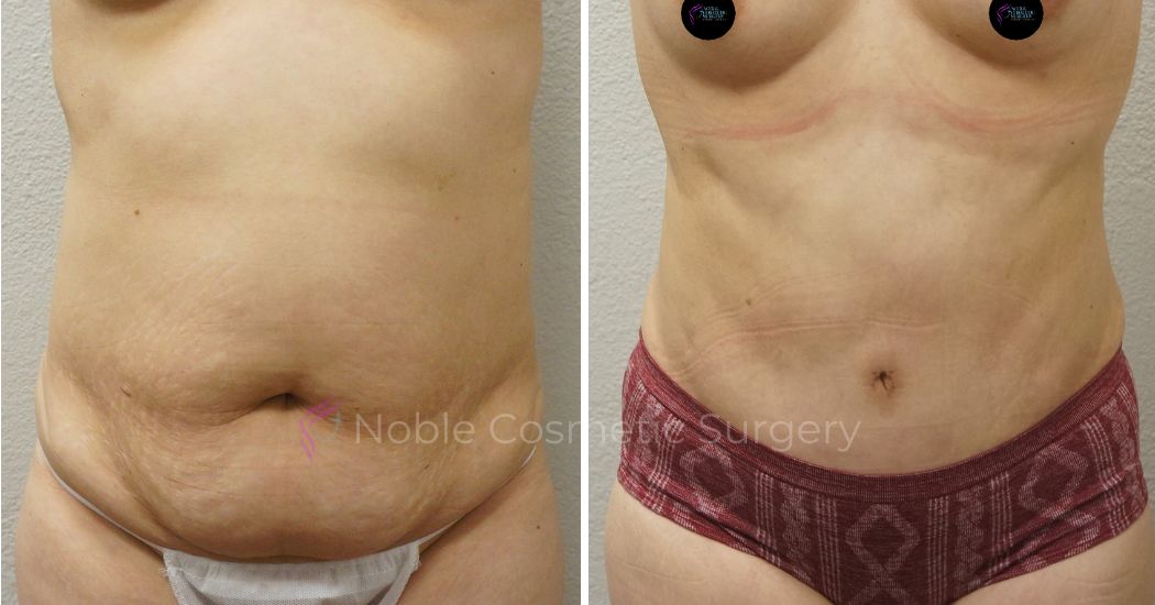 P18-00049A | Before and After Abdominoplasty