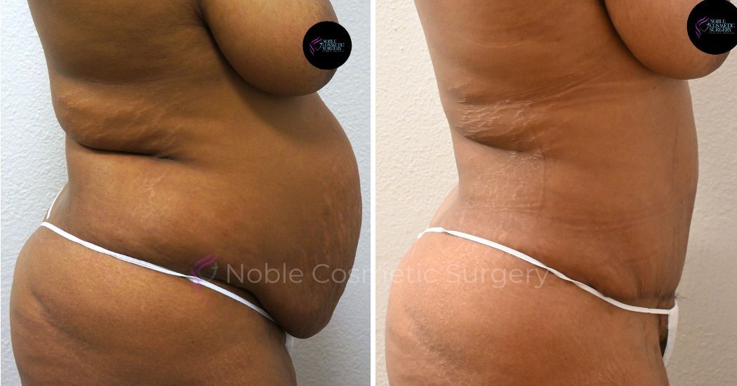 P2-00033A | Before and After Abdominoplasty 2