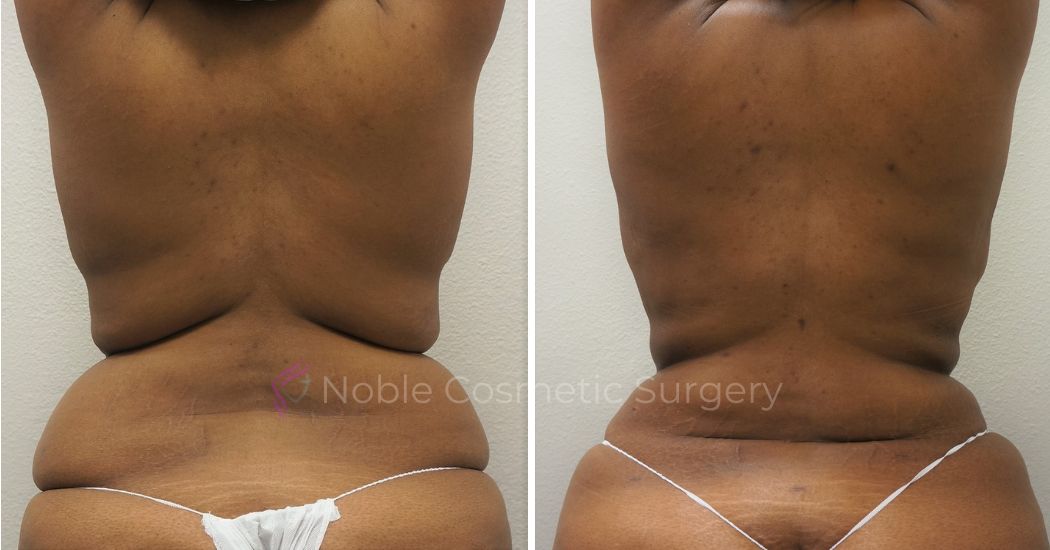 P20-00051A | Before and After Abdominoplasty 3