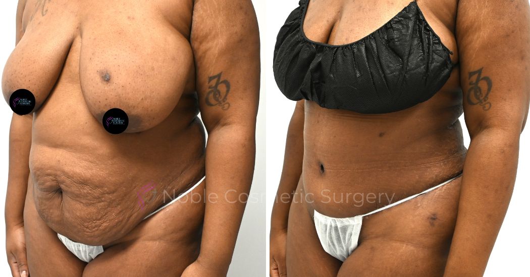 P28-00308A | Before and After Abdominoplasty 2