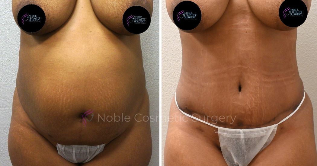 P3-00034A | Before and After Abdominoplasty 1
