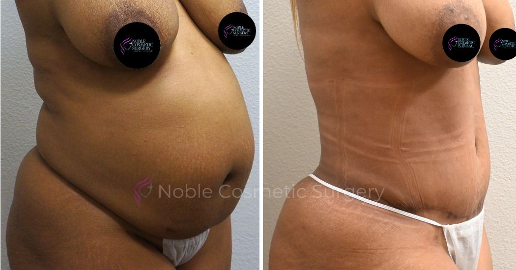 P3-00034A | Before and After Abdominoplasty 2