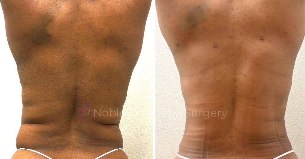 P3-00034A | Before and After Abdominoplasty 3