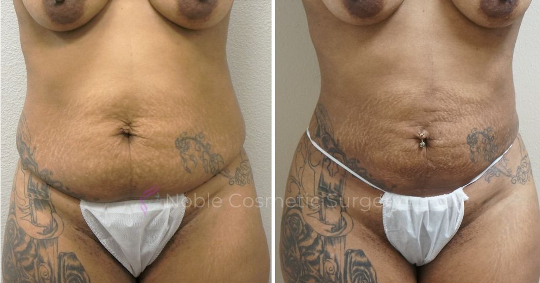 P3-00903L | Before and After Liposuction