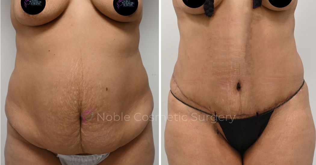 P34-00314A | Before and After Abdominoplasty