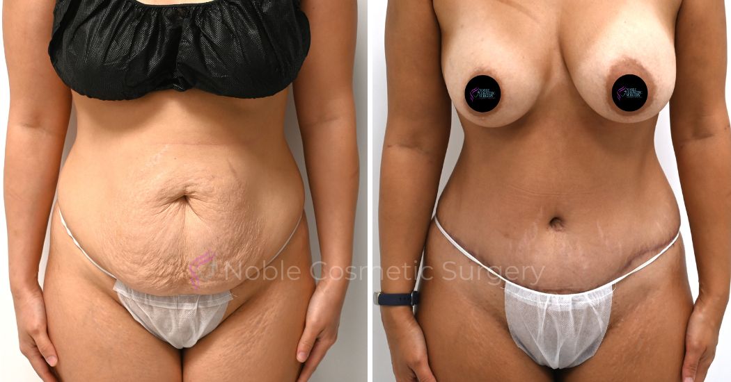 P36-00316A | Before and After Abdominoplasty