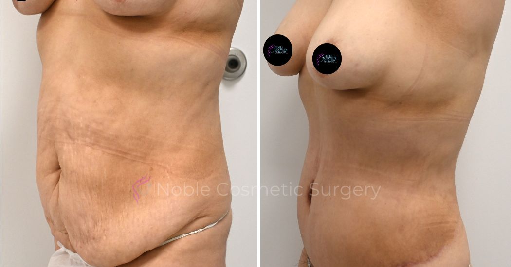 P37-00317A | Before and After Abdominoplasty 2