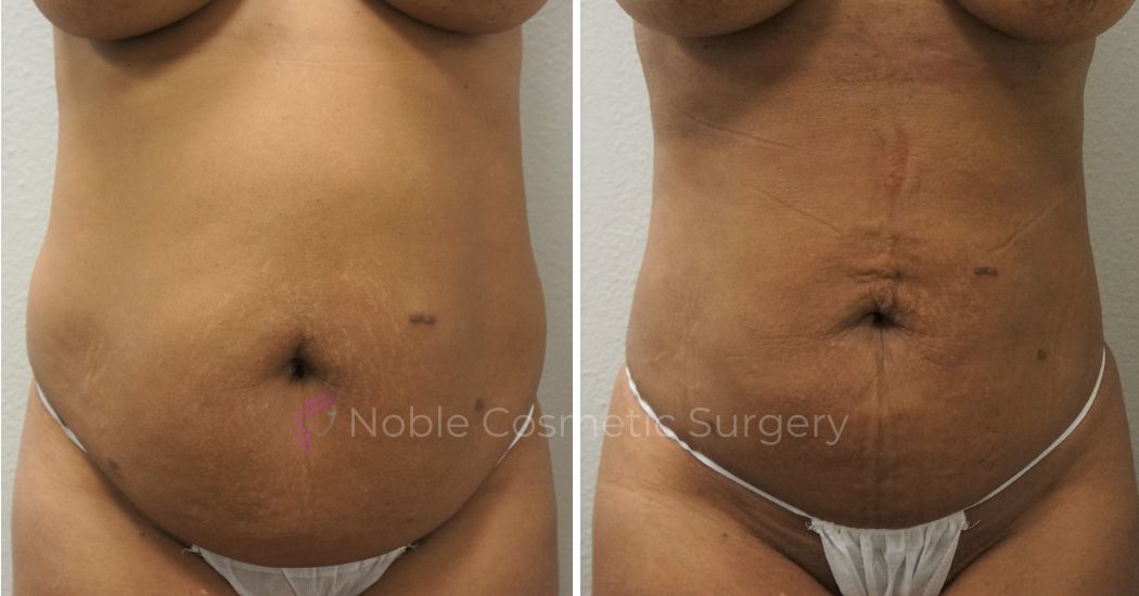 P4-00904L | Before and After Liposuction