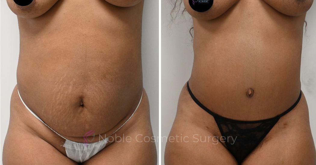 P44-00326A | Before and After Abdominoplasty