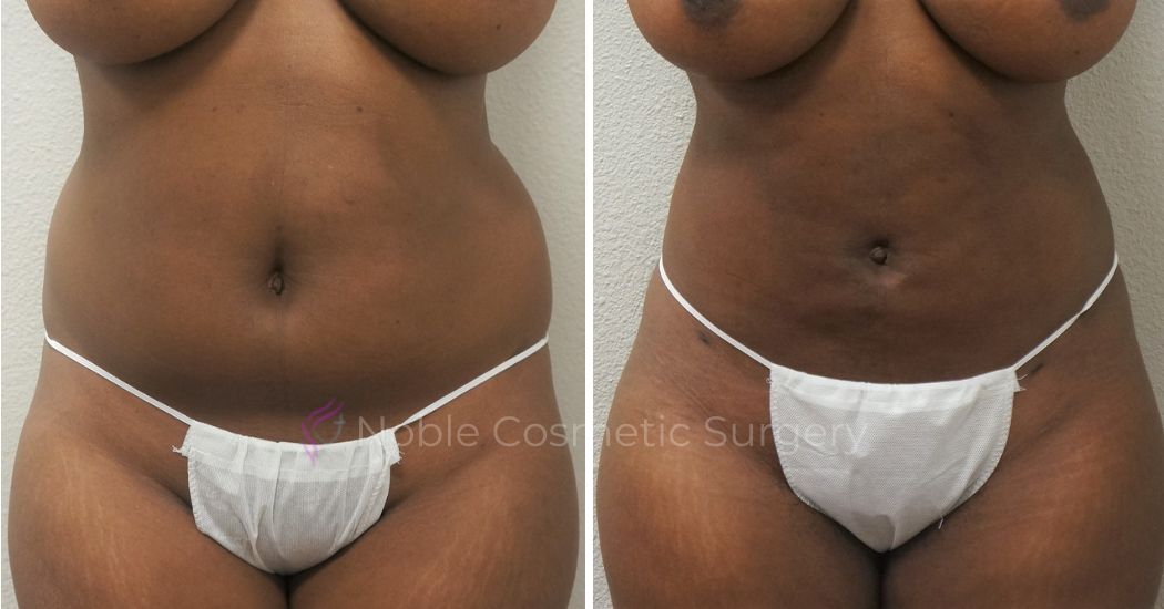 P5-00905L | Before and After Liposuction