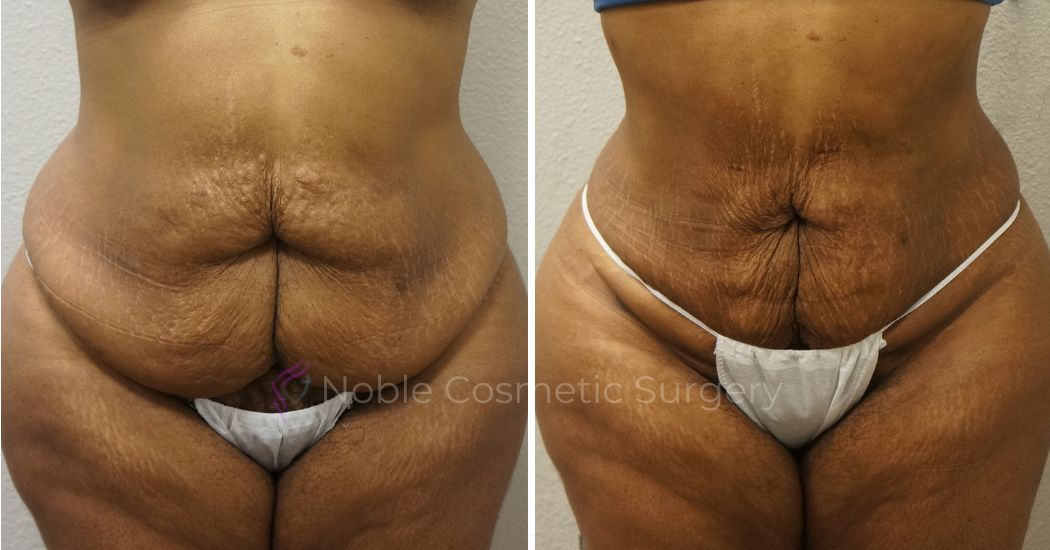 P6-00906L | Before and After Liposuction
