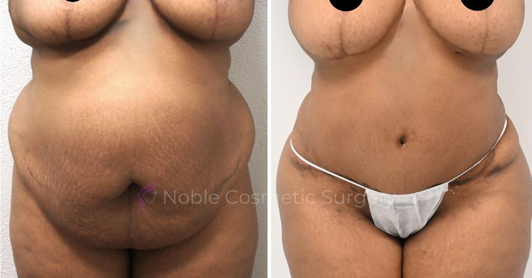 P7-00038A | Before and After Abdominoplasty 1