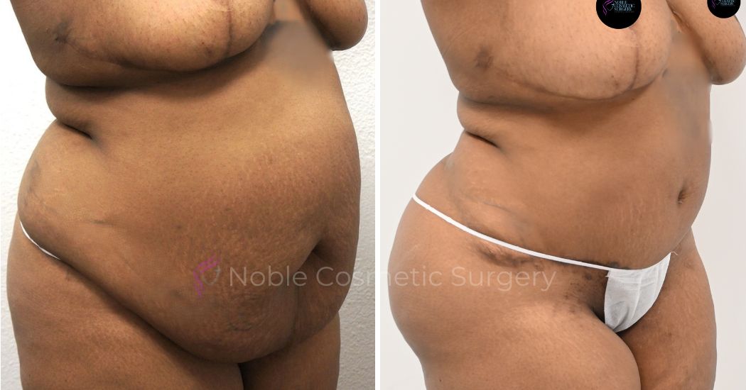 P7-00038A | Before and After Abdominoplasty 2