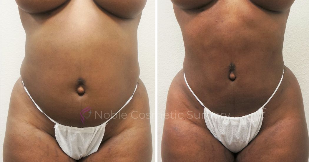P7-00907L | Before and After Liposuction