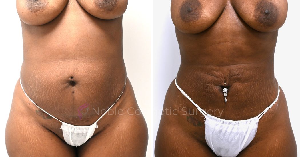 P8-00908L | Before and After Liposuction