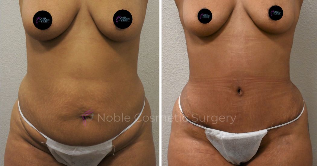 P9-00040A | Before and After Abdominoplasty 1