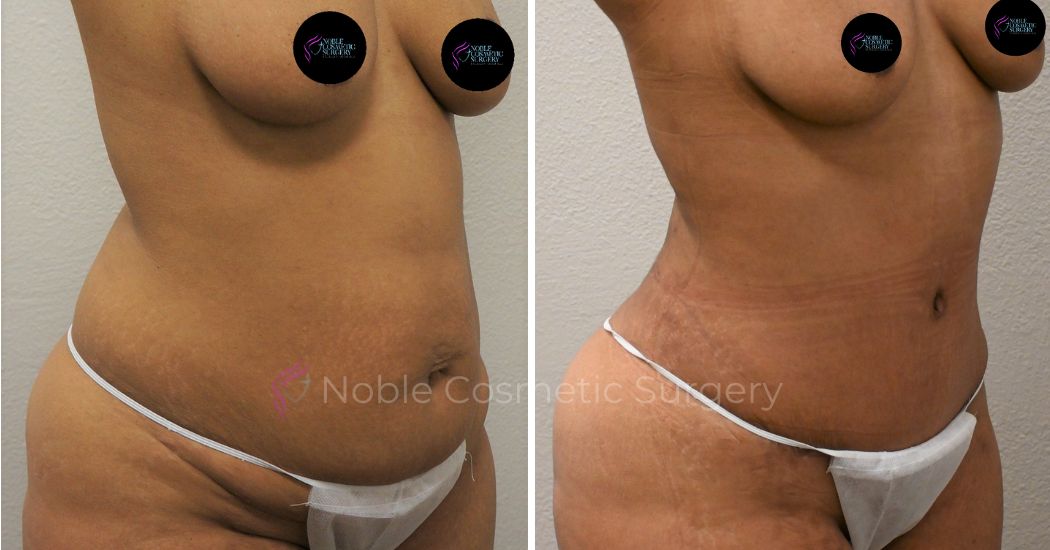 P9-00040A | Before and After Abdominoplasty 2