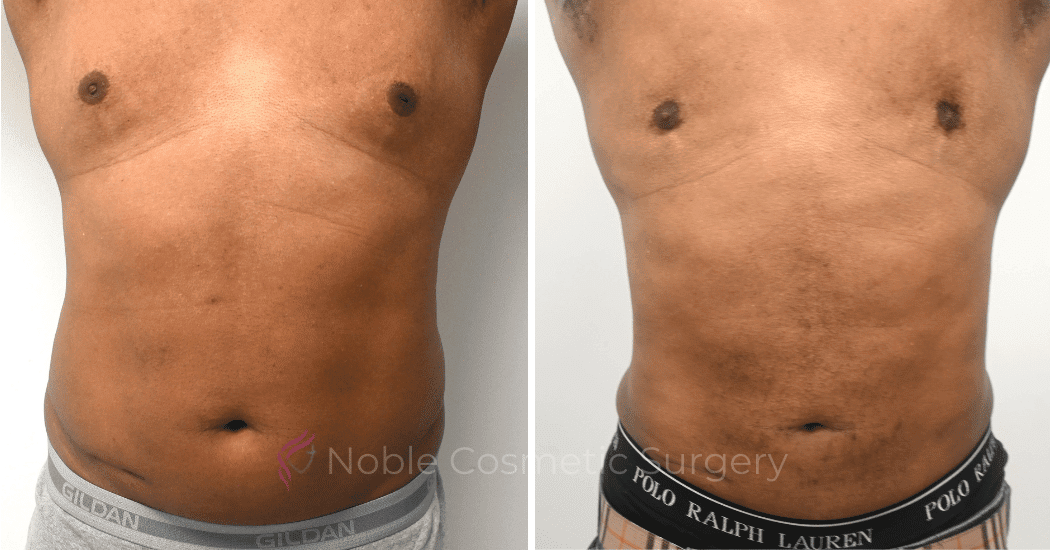 GYNECOMASTIA-CASE-10270 | Before and After Gynecomastia 1