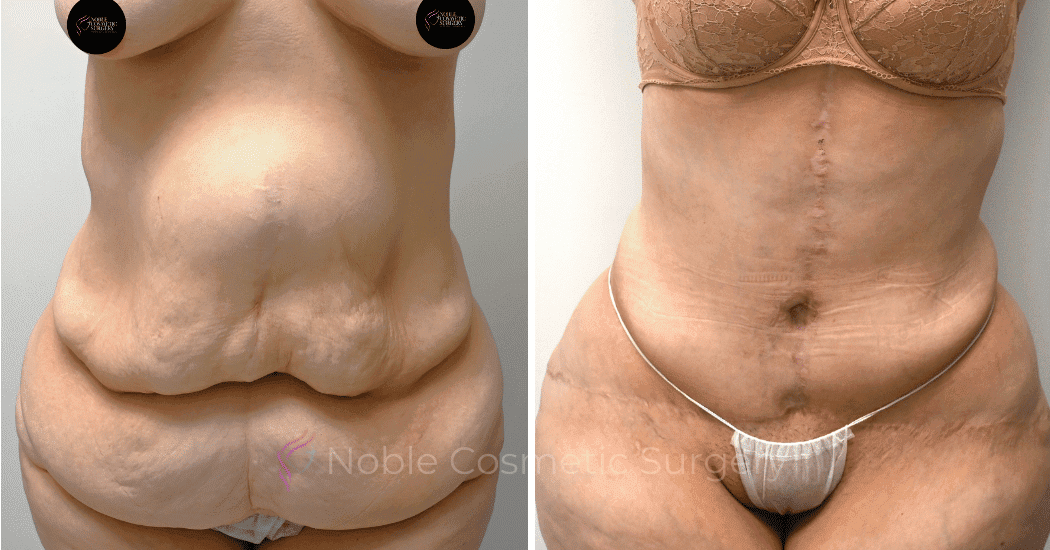 TUMMY-TUCK-CASE-10950 | Before and After Abdominoplasty 1