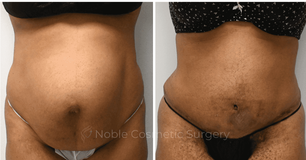 TUMMY-TUCK-CASE-11974 | Before and After Abdominoplasty 1