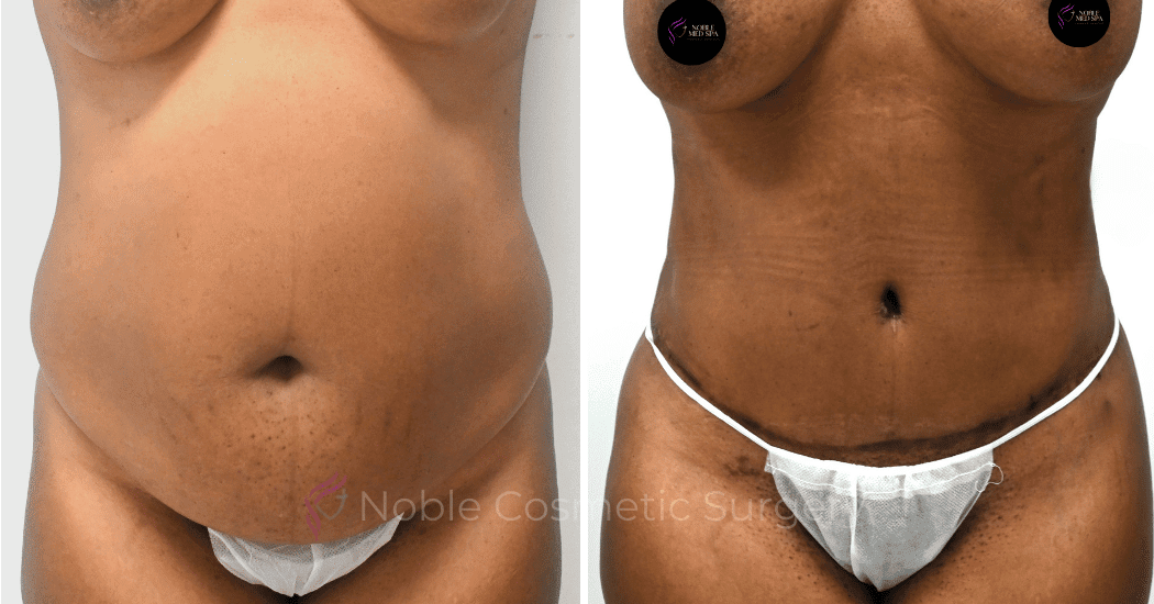TUMMY-TUCK-CASE-12002 | Before and After Abdominoplasty 1