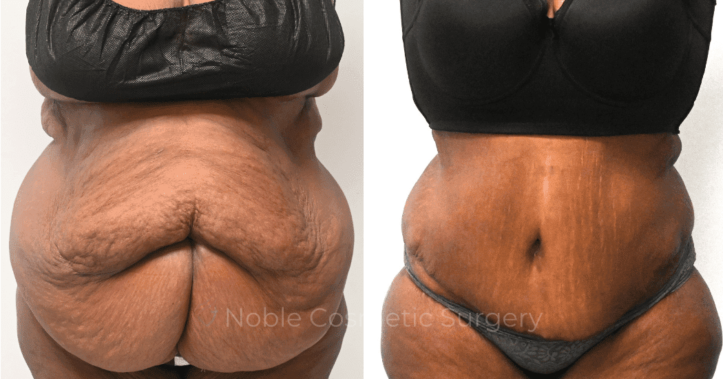 TUMMY-TUCK-CASE-14955 | Before and After Abdominoplasty 1