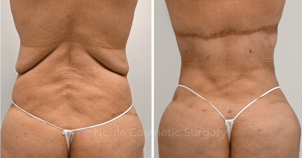 BACK-LIFT-CASE-00251 | Before and After Back Lift 1