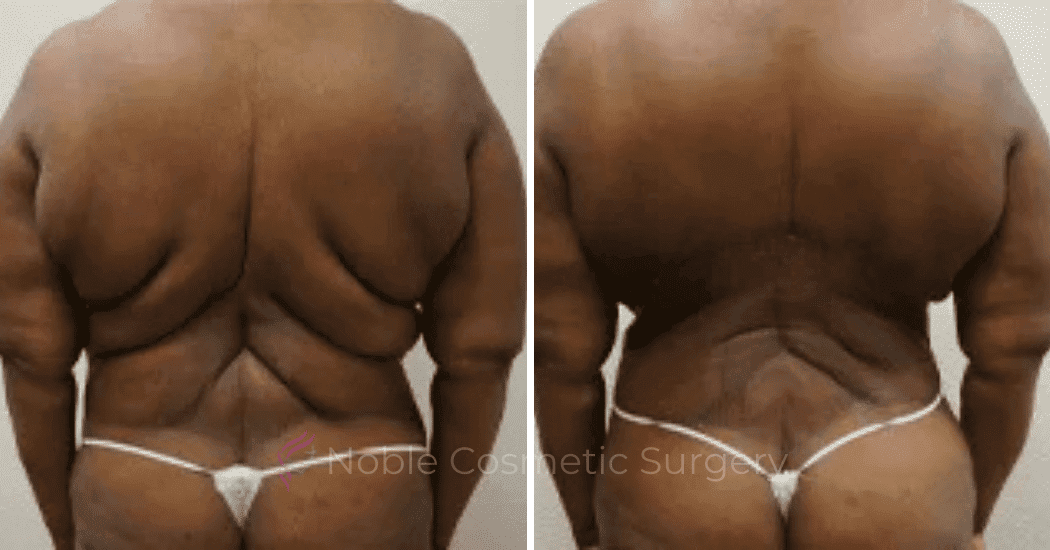 BACK-LIFT-CASE-00252 | Before and After Back Lift 1